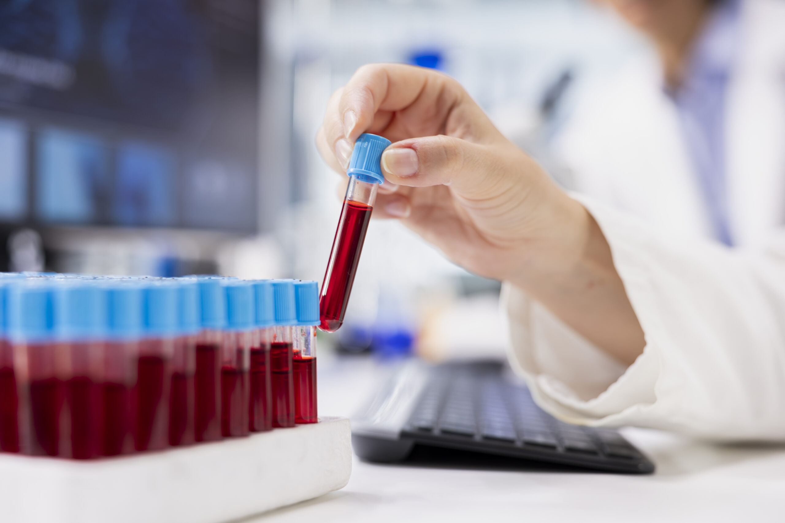 Alzheimer’s blood test could identify risk up to 10 years before symptoms start