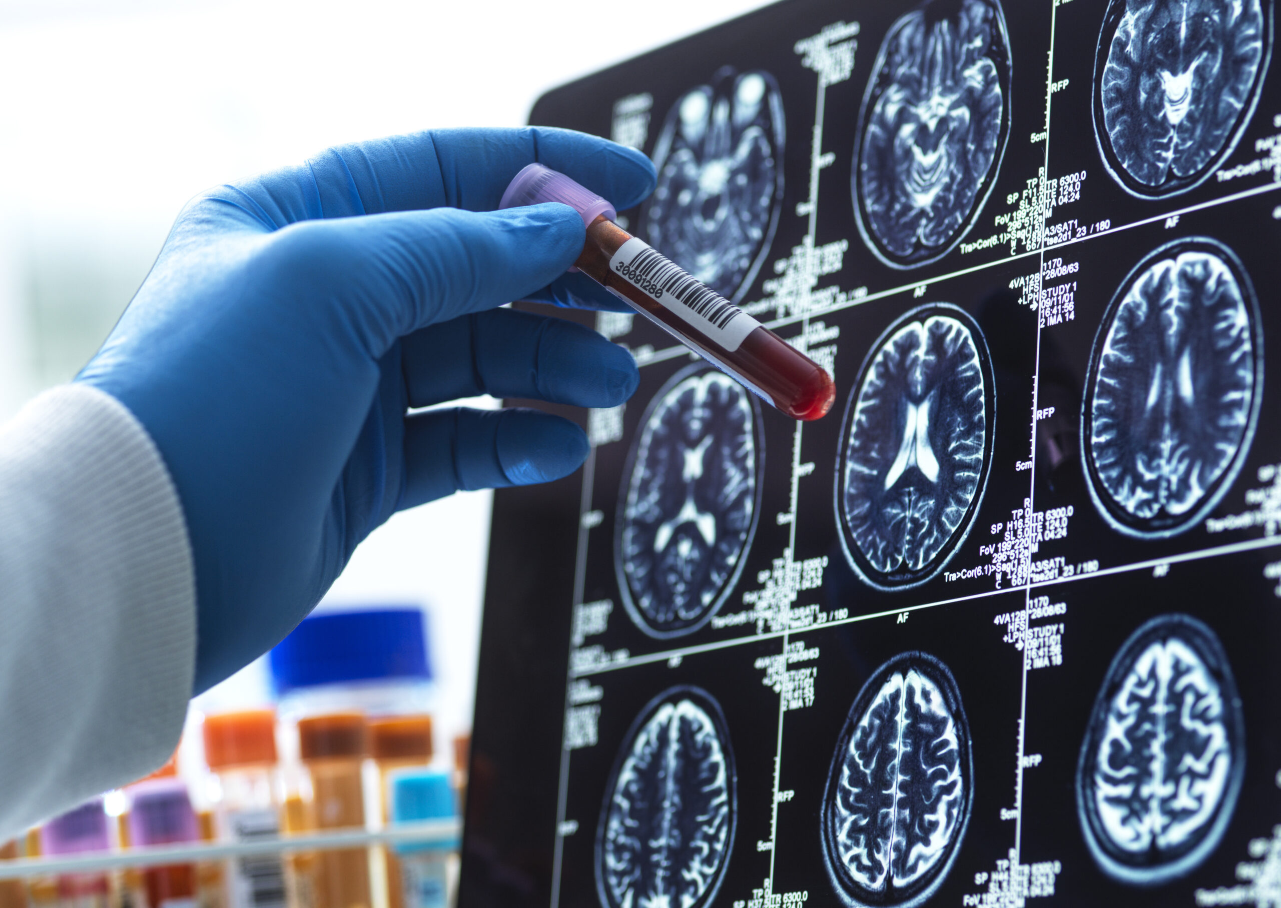 Lower cognitive test scores in your 60s could indicate stroke risk